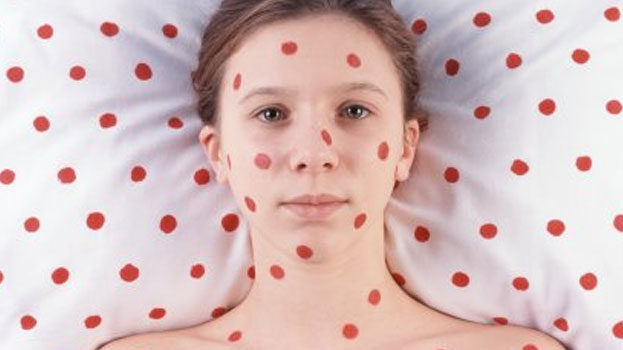 Sự nguy hiểm của virus rubella với thai phụ