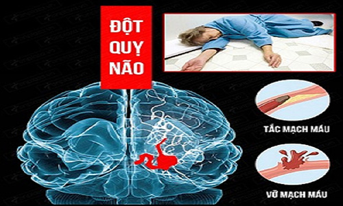 Đột quỵ não căn bệnh có tỷ lệ tử vong cao