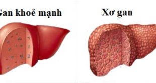 Kỹ thuật Xét nghiệm Y học phát hiện sớm bệnh sơ gan