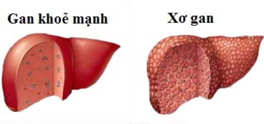 Sơ gan căn bệnh nguy hiểm có tỷ lệ tử vong cao