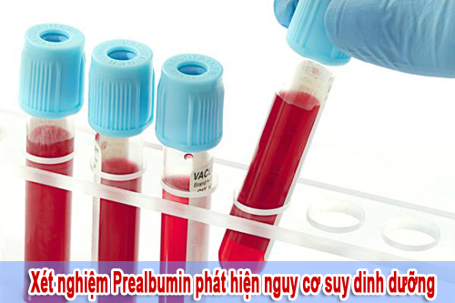 Xét nghiệm Prealbumin là gì?