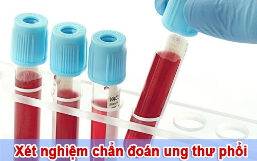 Xét nghiệm máu có chẩn đoán được bệnh ung thư phổi?