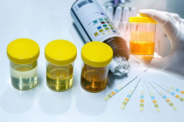 Mẫu nước tiểu cần được thu thập đúng cách để đảm bảo kết quả chính xác