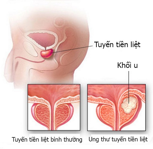 xet-nghiem-tien-liet-tuyen